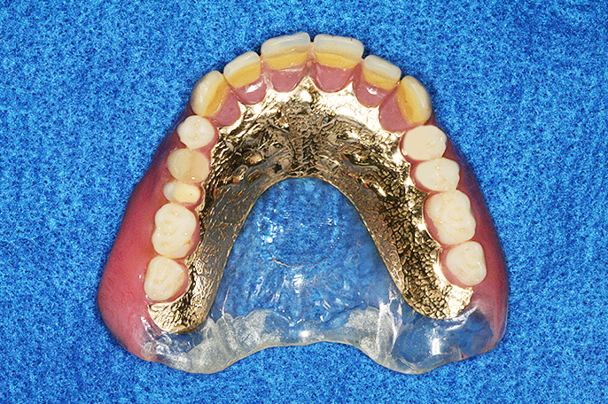 みとべ歯科で使用の金属床義歯